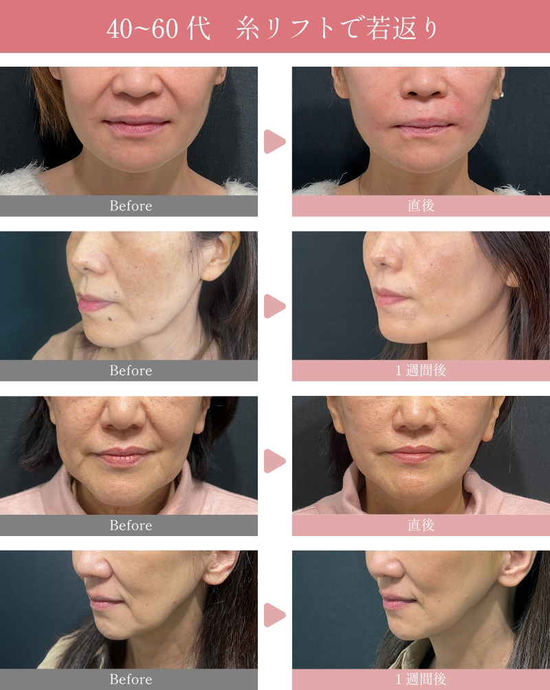 40～60代の糸リフト症例✨