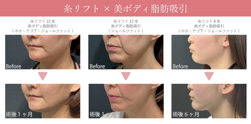 糸×脂肪吸引の若返り術が得意な先生