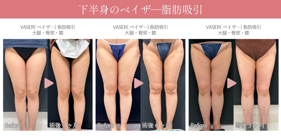 下半身(太もも・お尻・膝)の脂肪吸引の症例🦵