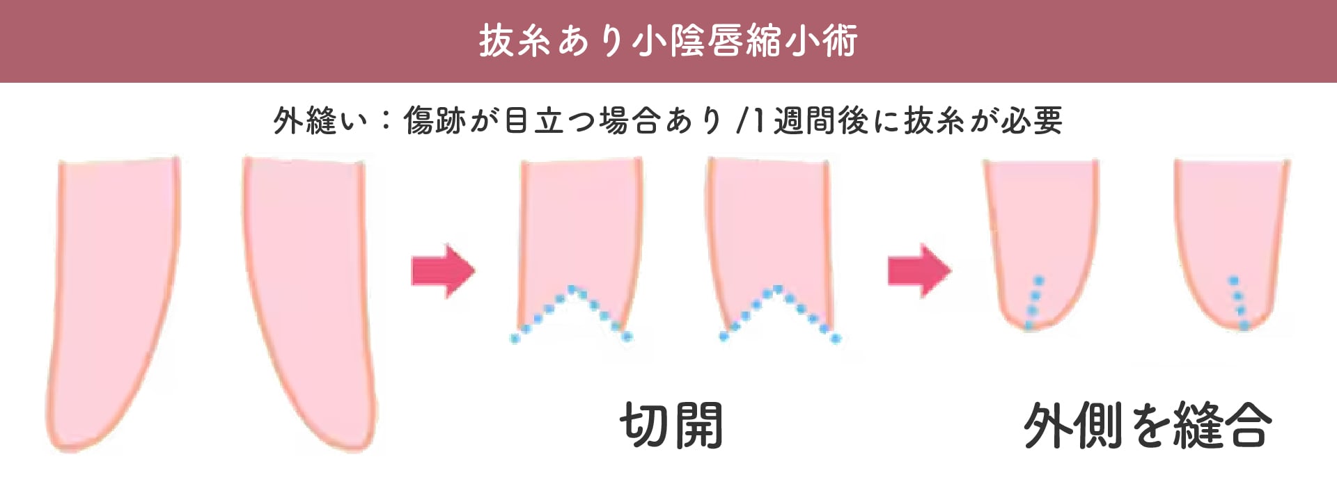 抜糸ありの縫合