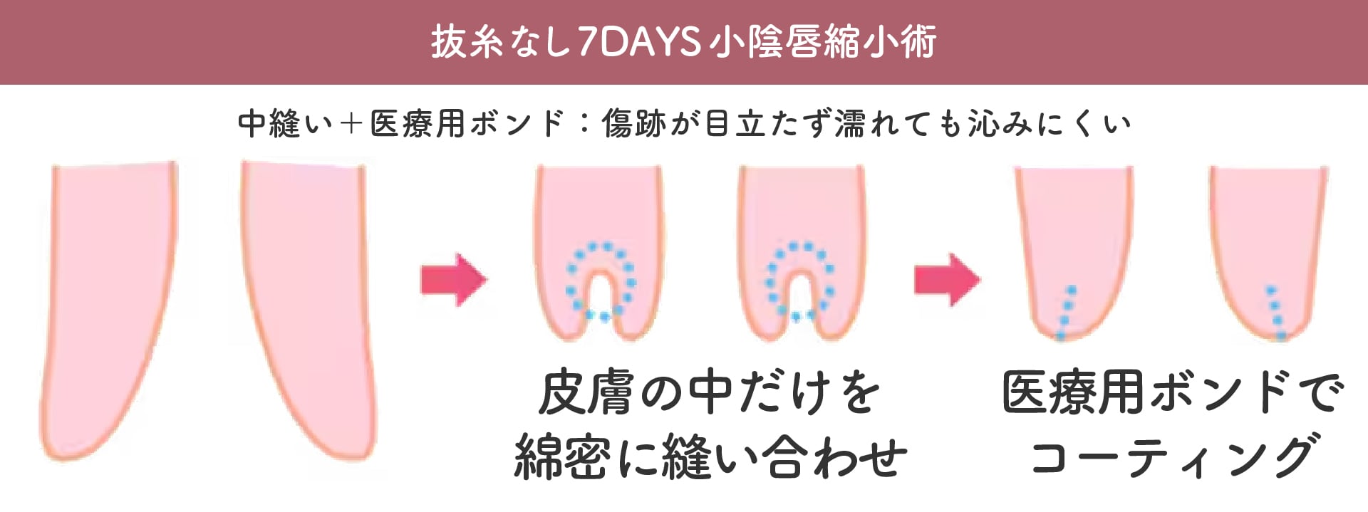 抜糸なしの縫合