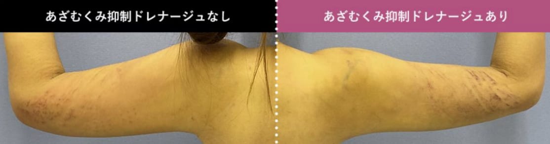 【無料オプション】あざむくみ抑制ドレナージュでダウンタイムを最小限に！