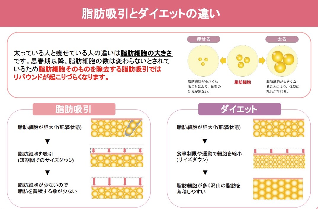 脂肪吸引の仕組みと期待できる効果