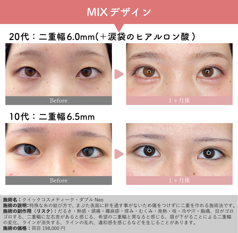 MIX二重でいいとこ取りの目元へ✨山部医師の症例カタログ