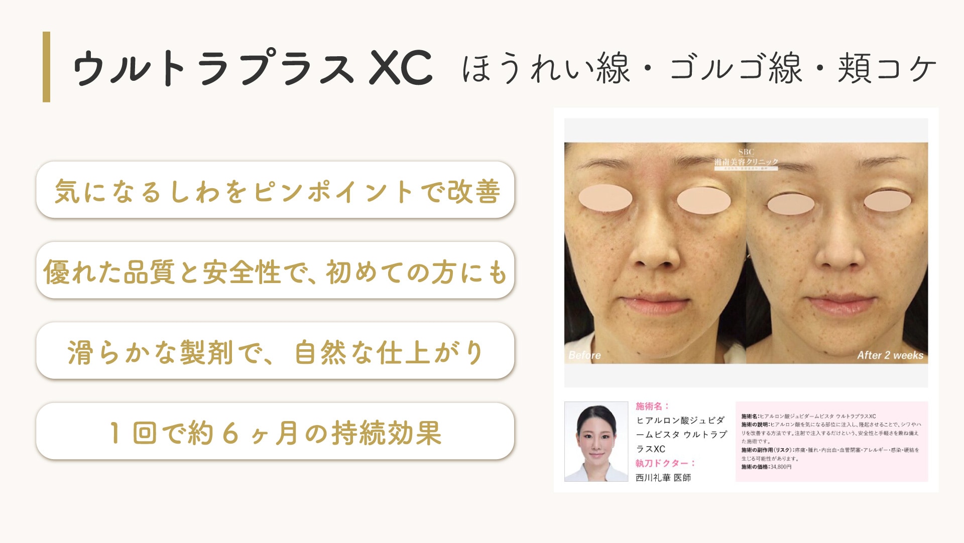 ジュビダームビスタウルトラプラスXC