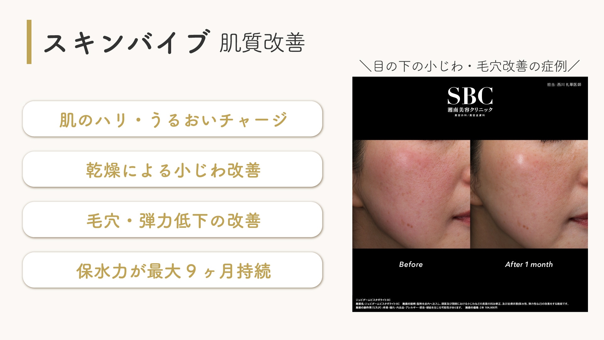 スキンバイブ／SKINVIVE(ジュビダームビスタボライトXC)