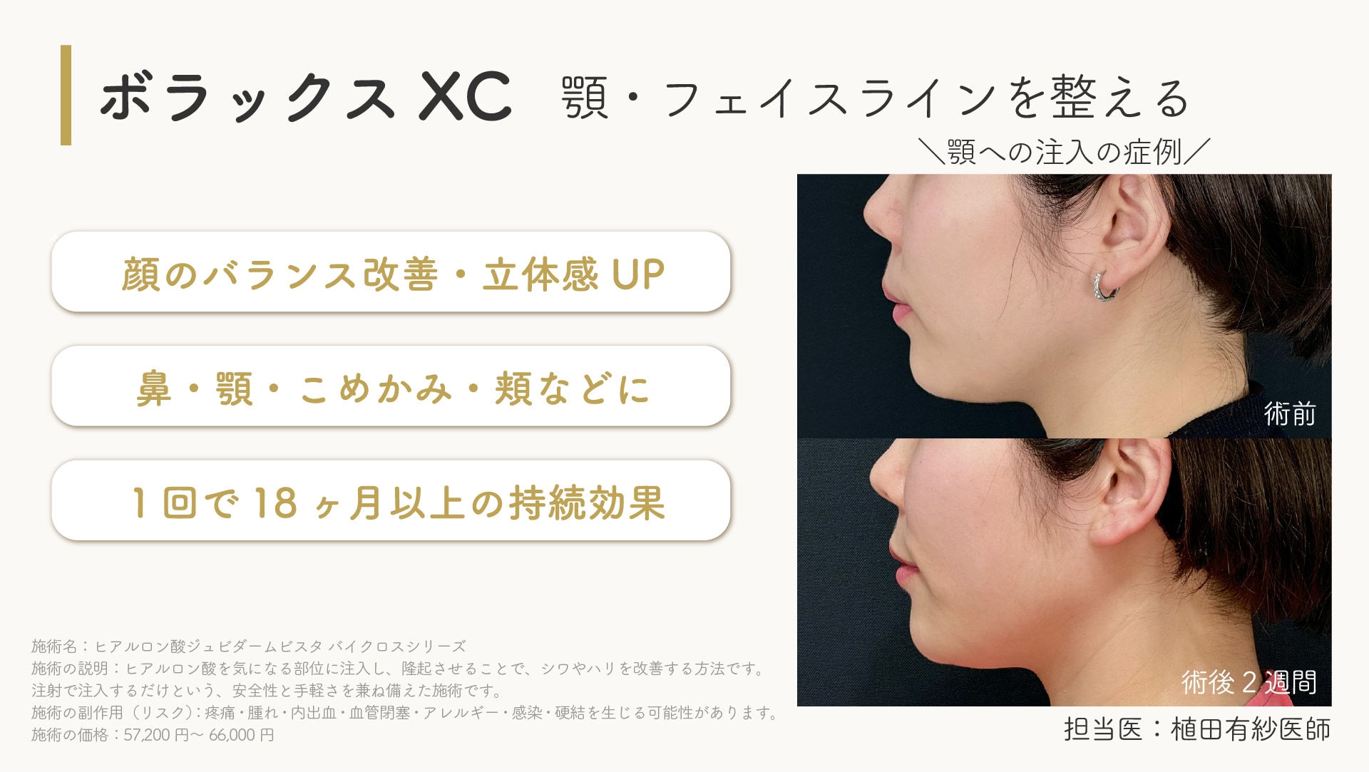 ジュビダームビスタボラックスXC