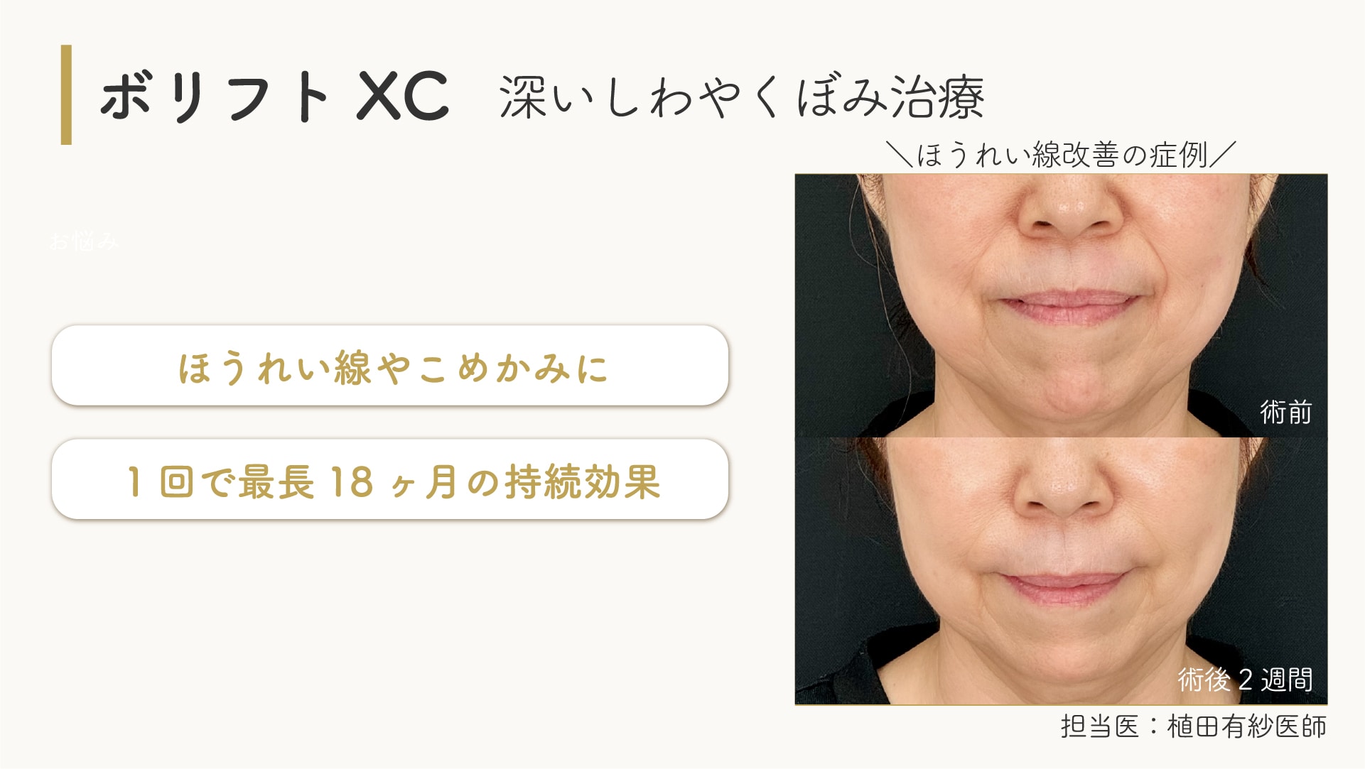 ジュビダームビスタボリフトXC