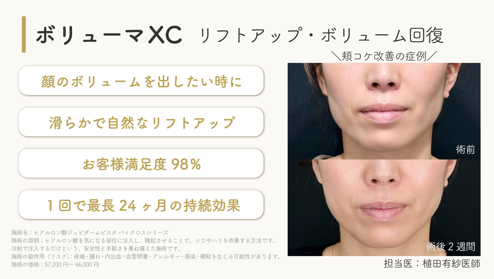 ジュビダームビスタボリューマXC