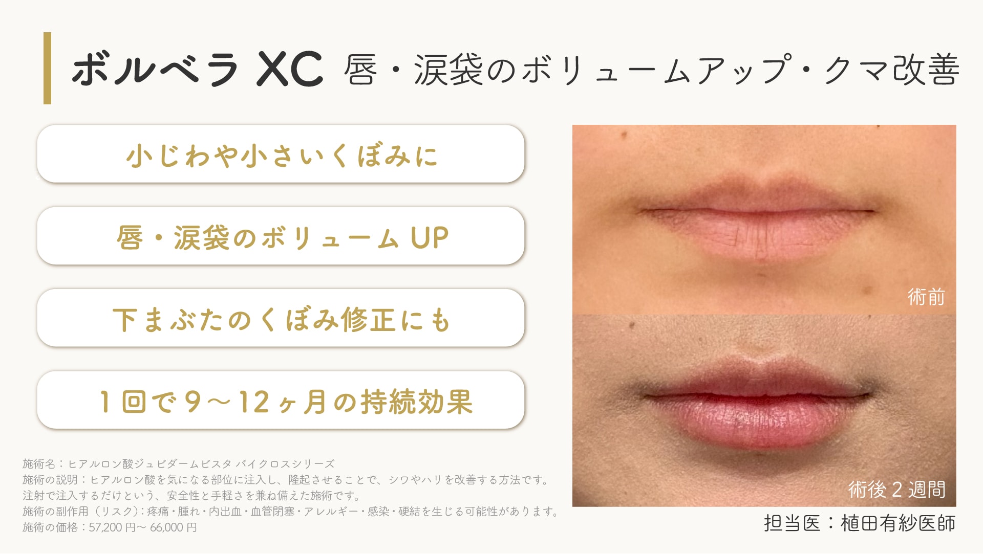 ジュビダームビスタボルベラXC