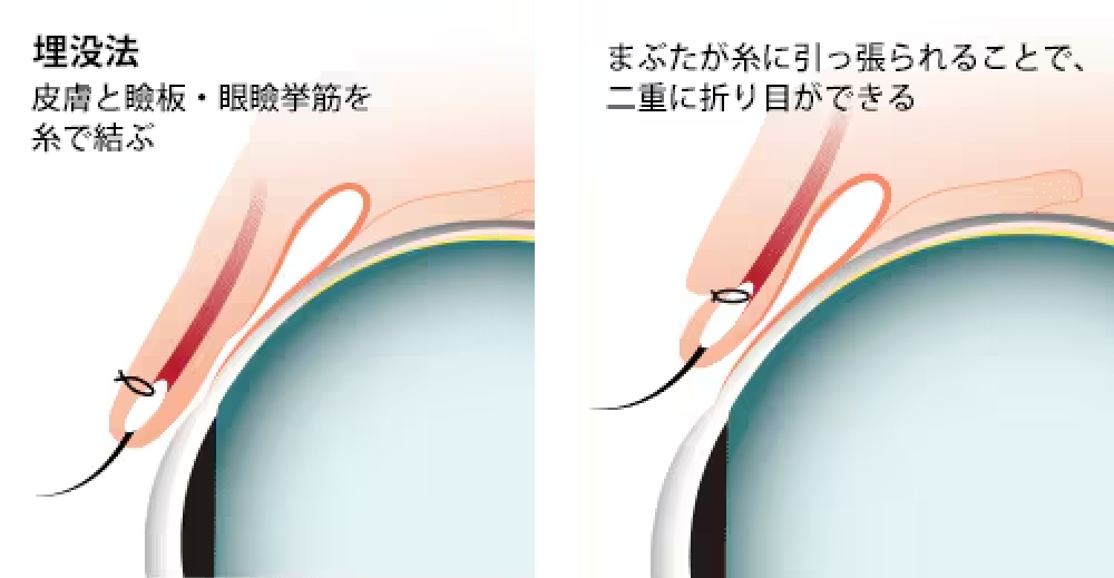 湘南美容クリニック高知院の二重整形（埋没法）とは