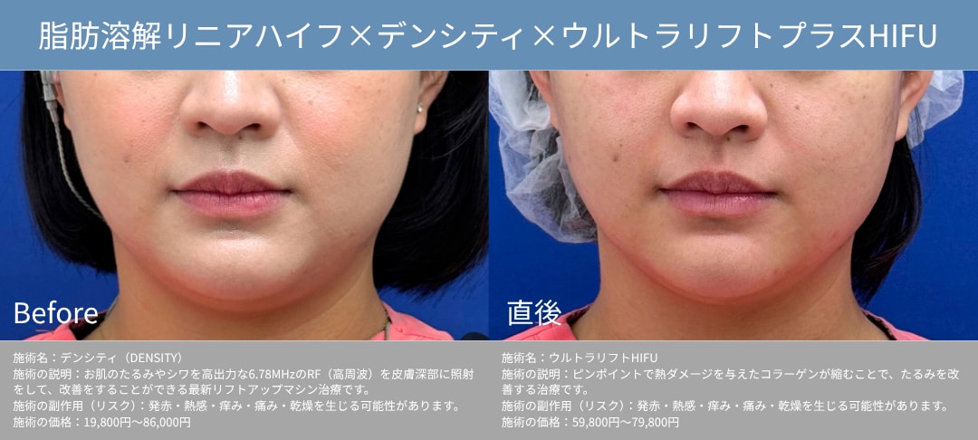 たるみ・もたつきにはデンシティ×ハイフ