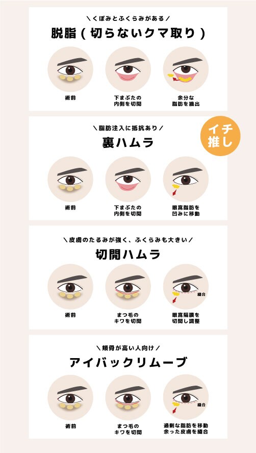 SBCには4種類の治療があります