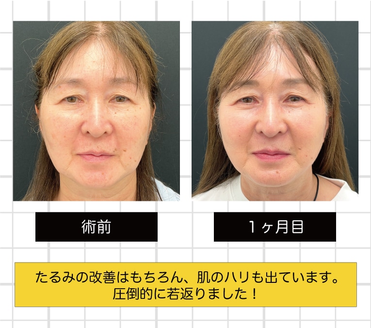 術前と1ヶ月目の比較
