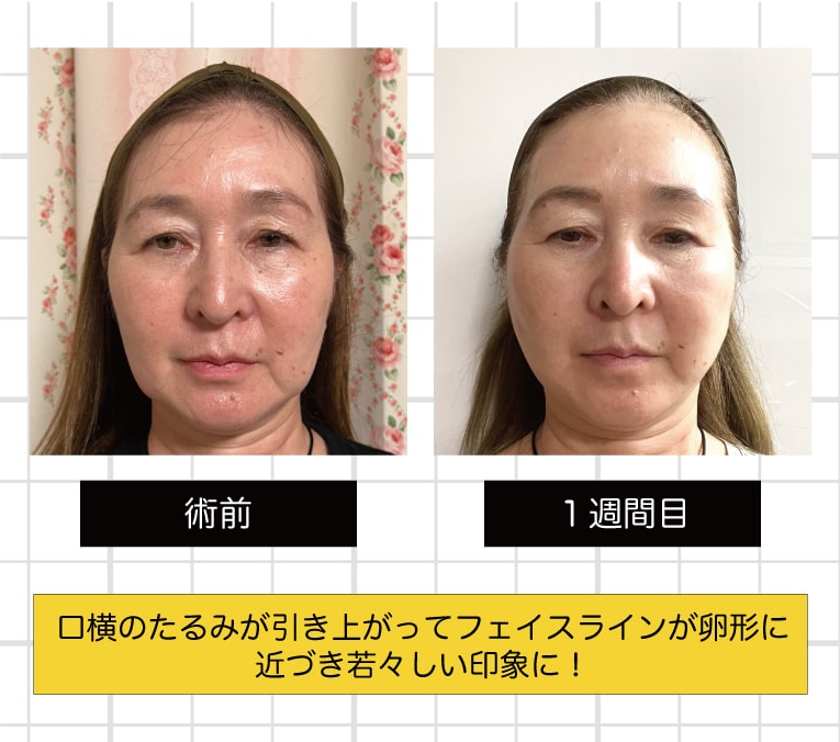術前と1週間目の比較