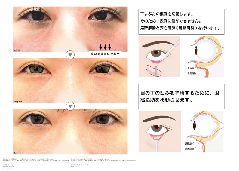眼窩脂肪は活かす