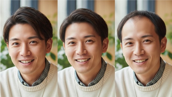 男性ホルモン型脱毛症のこと！