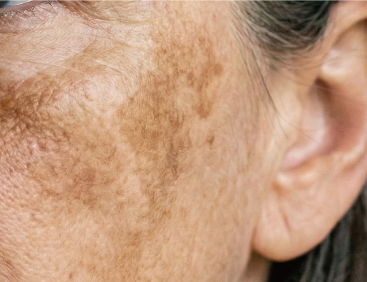 厄介な肝斑に対応！