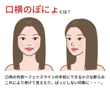 その名の通り、ぽにょっとした膨らみ