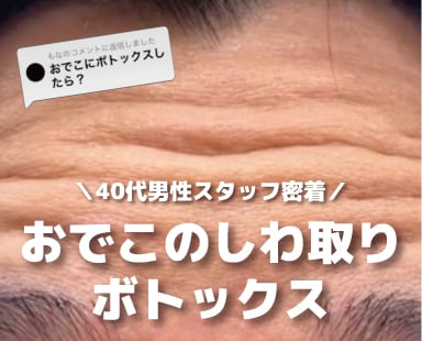 【男性スタッフに密着】おでこのしわは本当にボトックスで改善&予防できるのか?熊谷周辺の北関東でメンズ美容・ボトックスなら湘南美容クリニック熊谷院