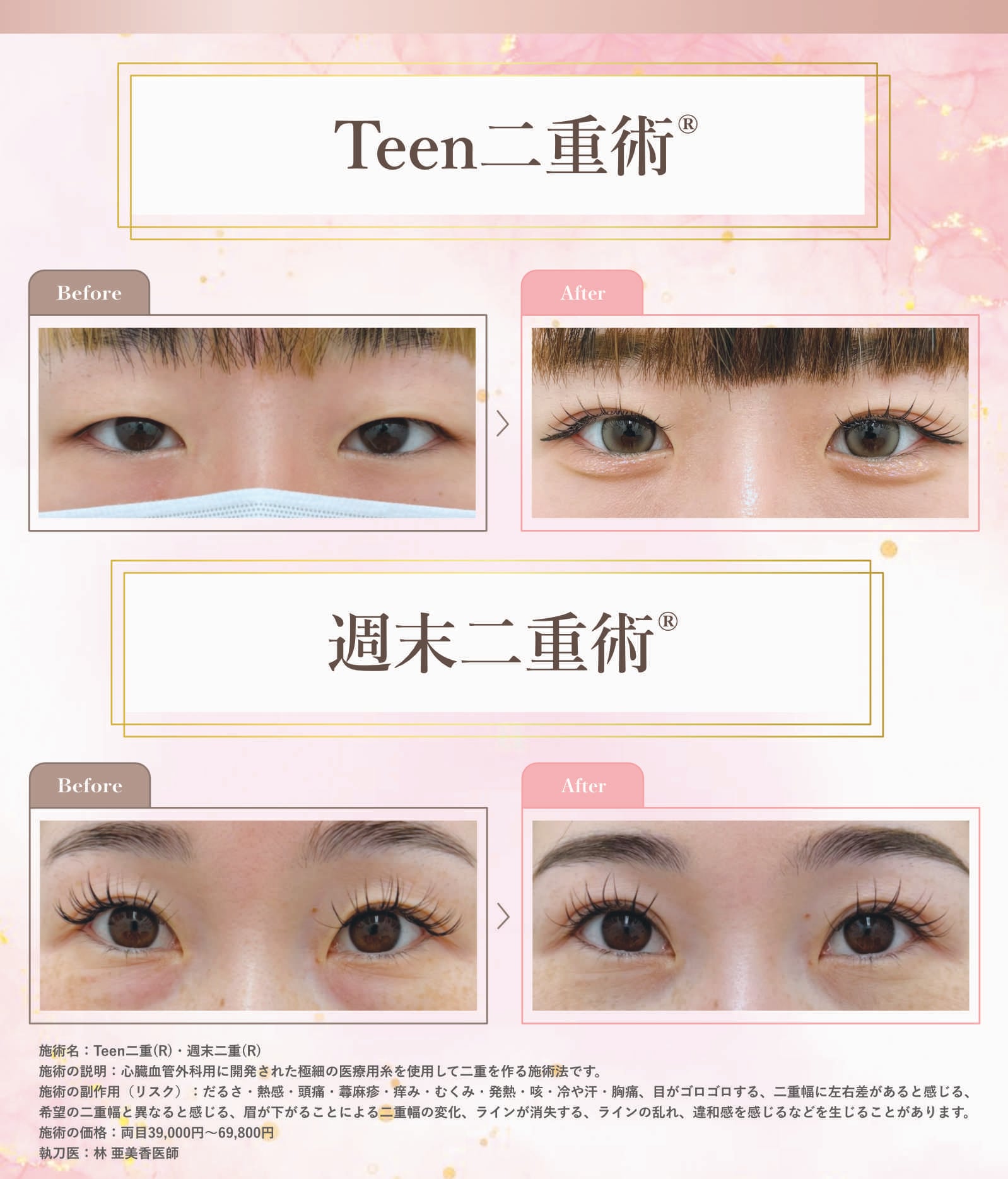 Teen二重術®・週末二重術®
