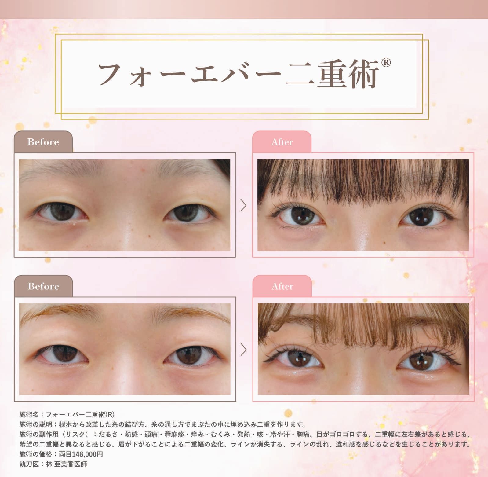 フォーエバー二重術®