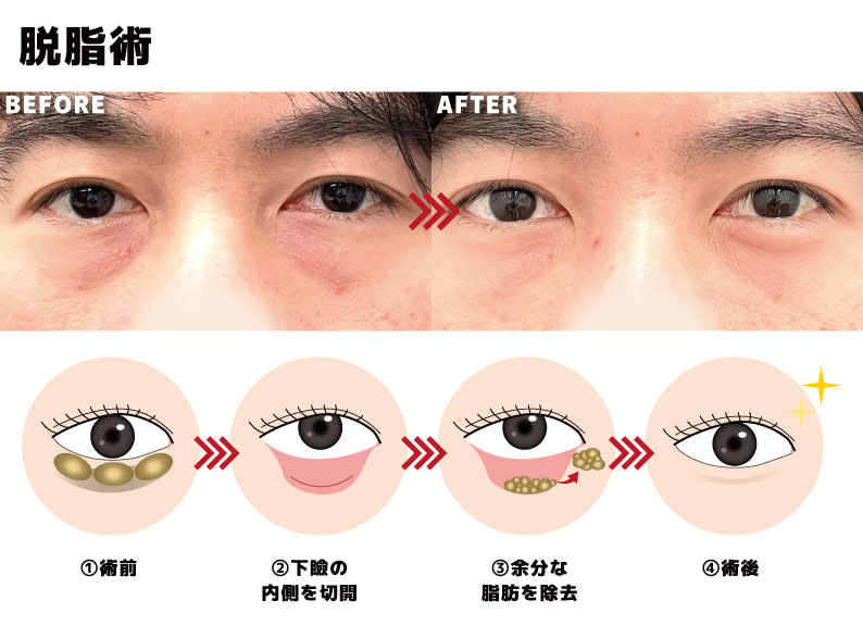 脱脂術