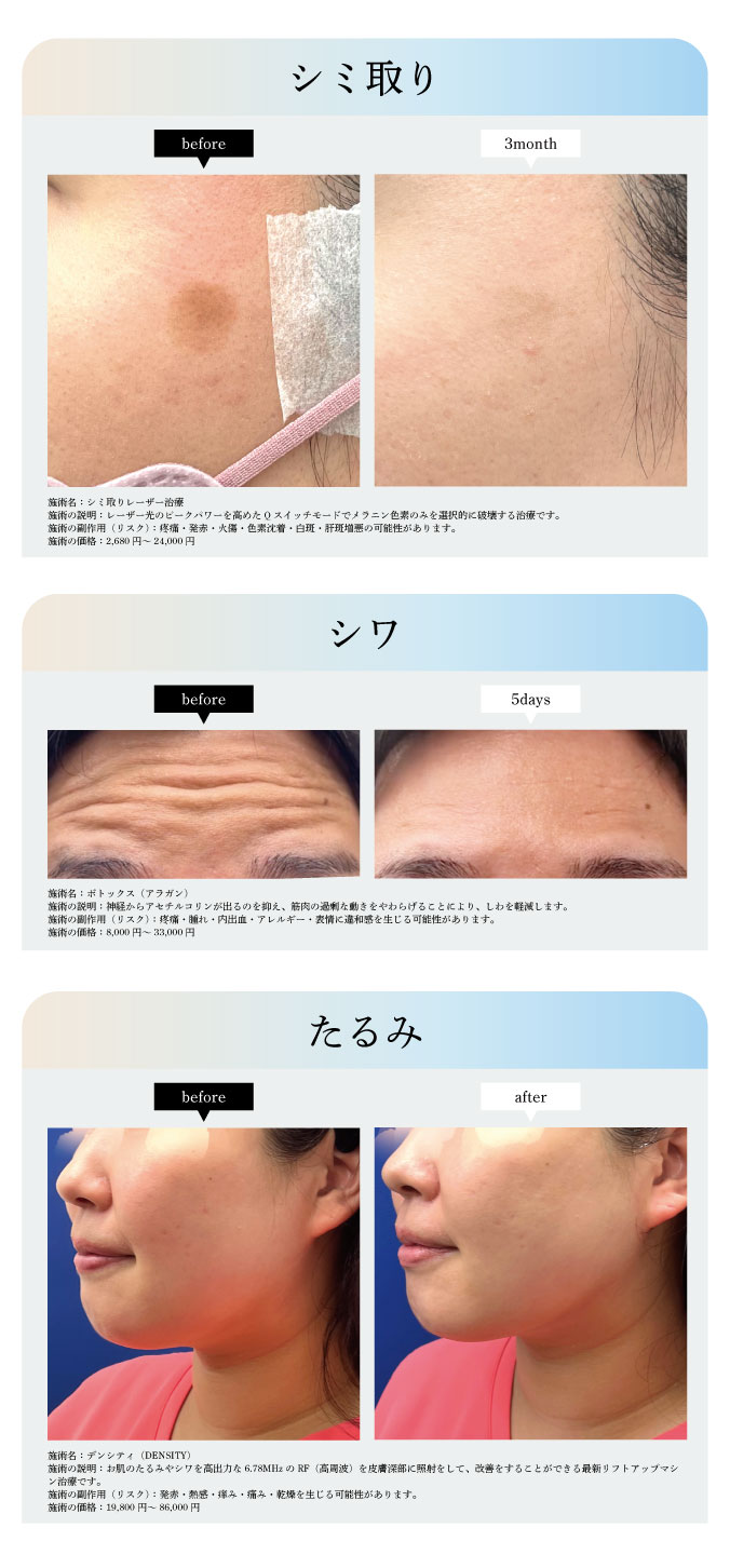 価格・ダウンタイム・痛みは最小限でアンチエイジングを叶える『YELLシリーズ』