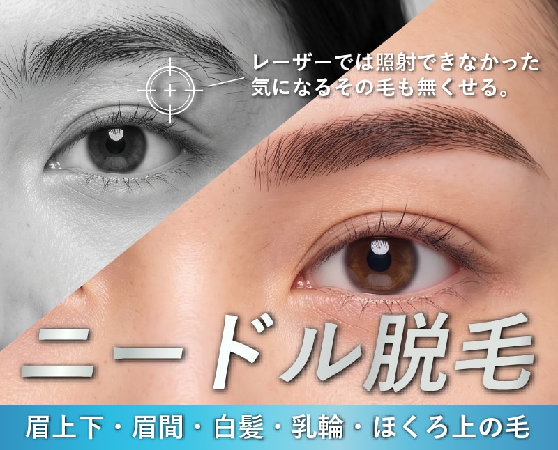 ニードル脱毛の特徴を徹底解説！熊谷で脱毛するなら、熊谷駅北口徒歩１分の湘南美容クリニック熊谷院へ！