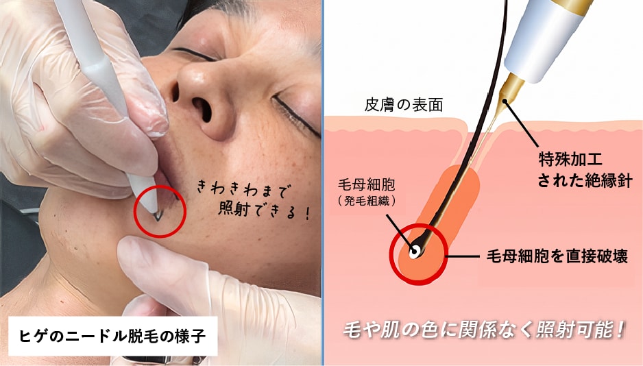 ニードル脱毛とは？
