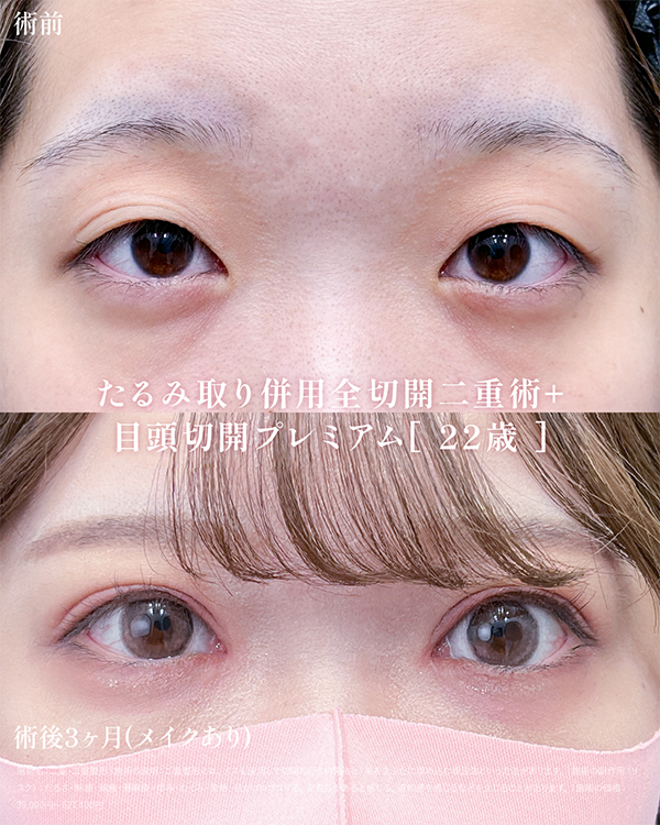 たるみ取り併用全切開二重術+目頭切開プレミアム