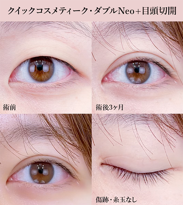 目頭切開プレミアム②