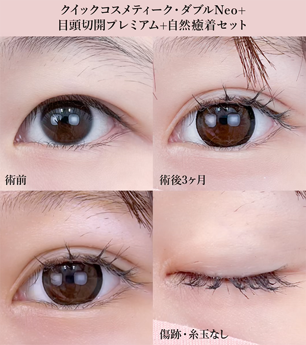 目頭切開プレミアム③