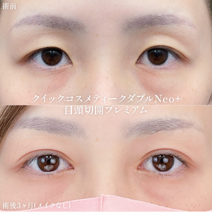 目頭切開プレミアム①