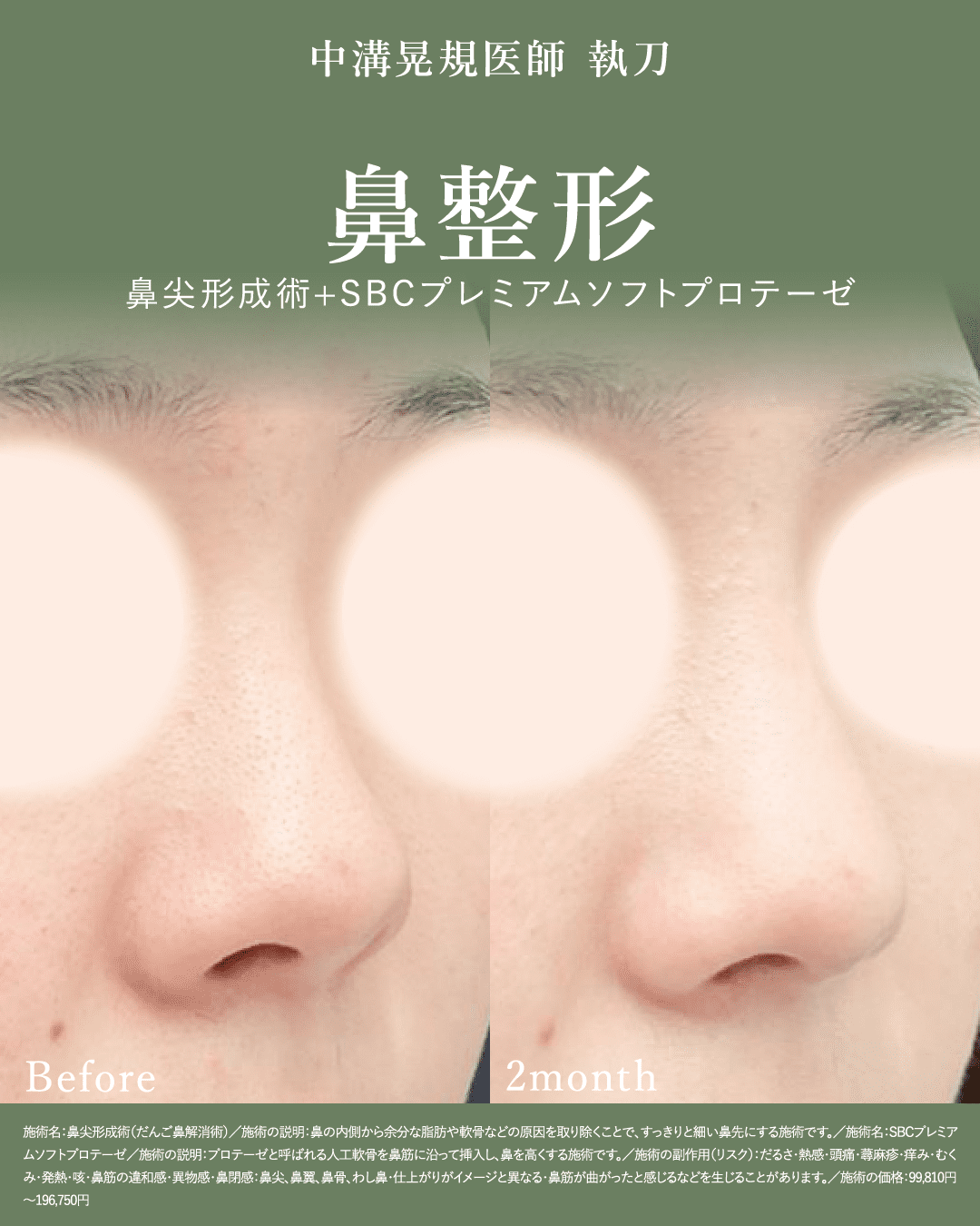 [鼻整形]鼻尖形成術＋SBCプレミアムソフトプロテーゼ