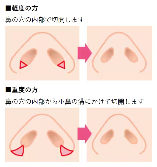 小鼻縮小術(内側法)