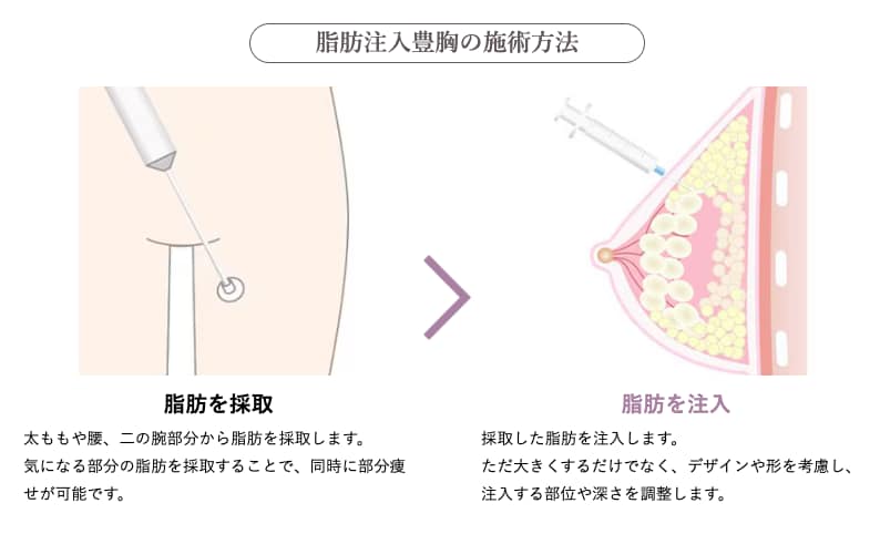 『脂肪注入豊胸』<br />
自分の脂肪で、どこまでもナチュラルに