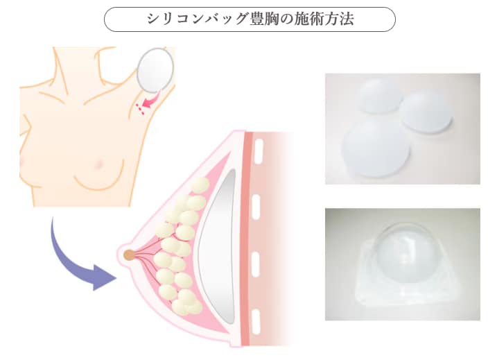 『シリコンバッグ豊胸』<br />
理想の形と大きさを、一度で叶える