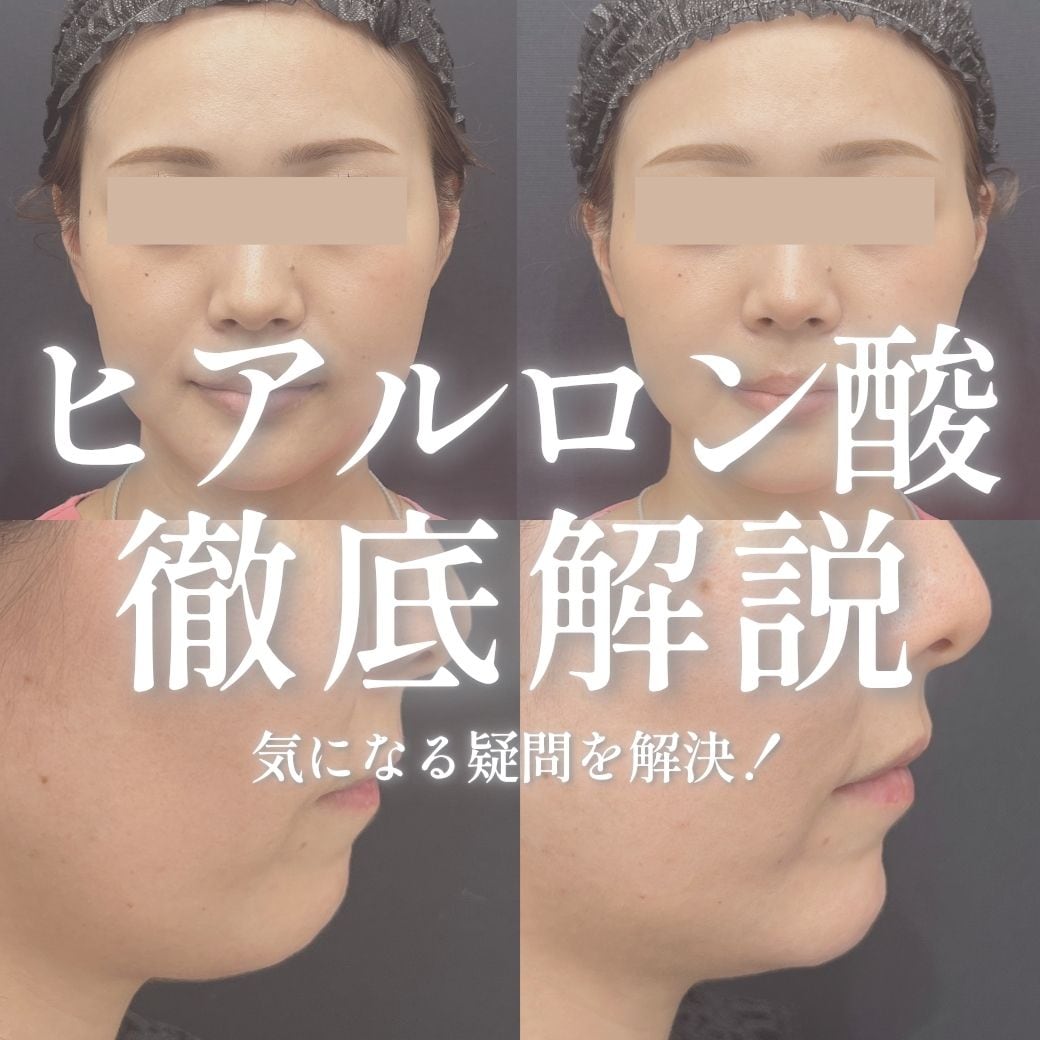 熊本でヒアルロン酸注射(注入)を受けるなら湘南美容クリニック熊本院にお任せください！