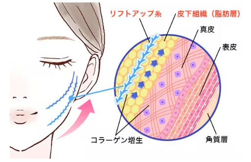 糸リフトの効果