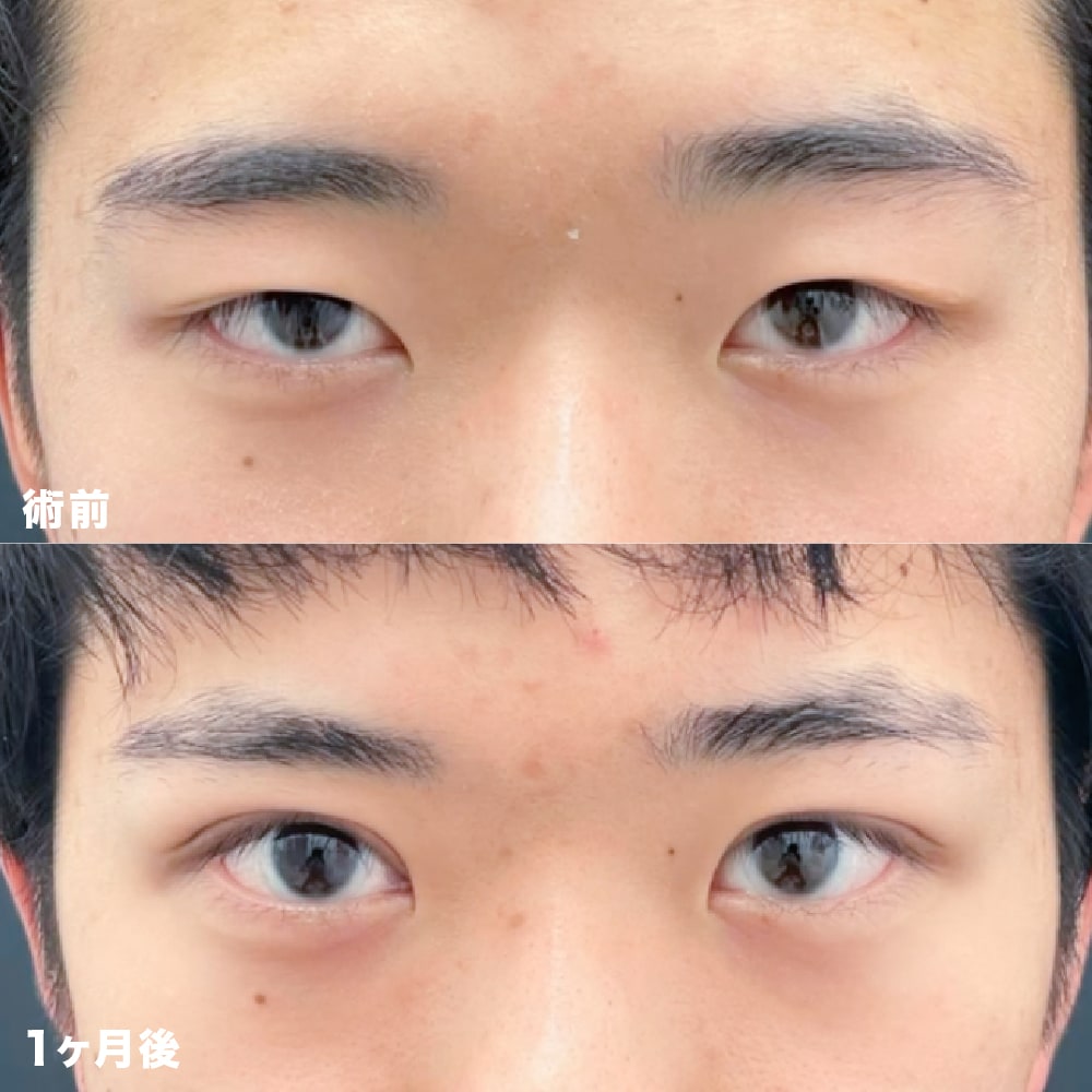 【二重整形】全切開二重術