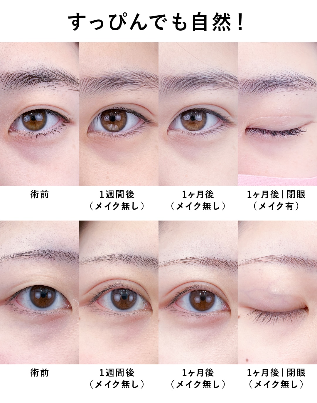 【高度なデザイン力】まるで生まれつきの二重に仕上げる
