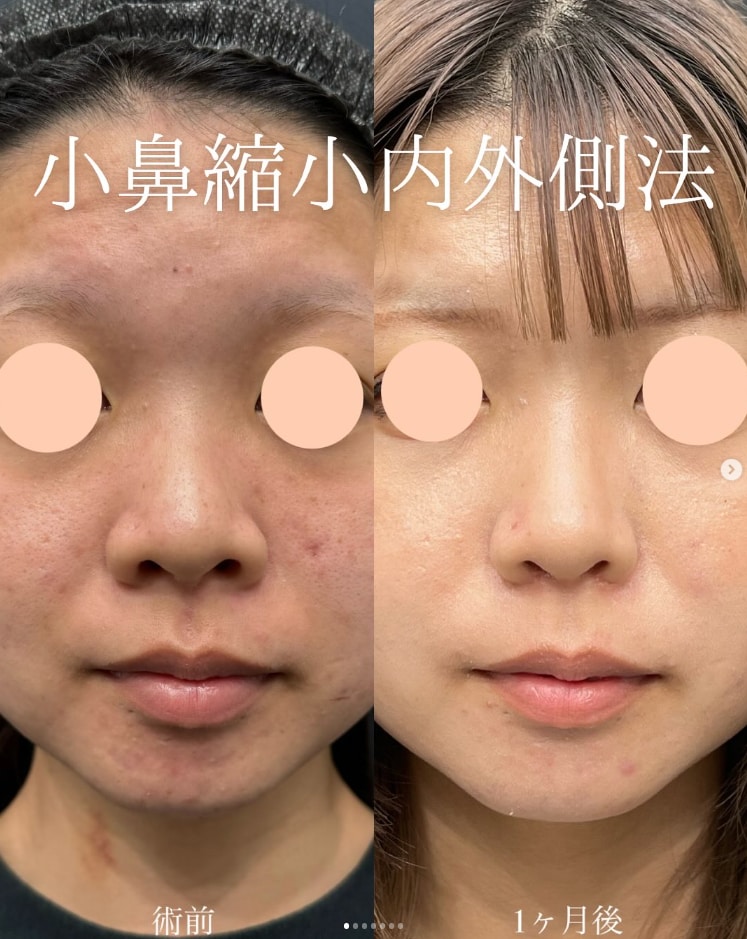 【鼻整形】小鼻縮小術