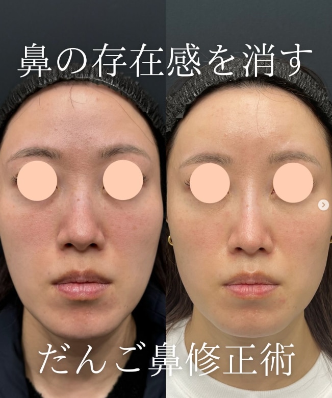 【鼻整形】鼻尖形成術