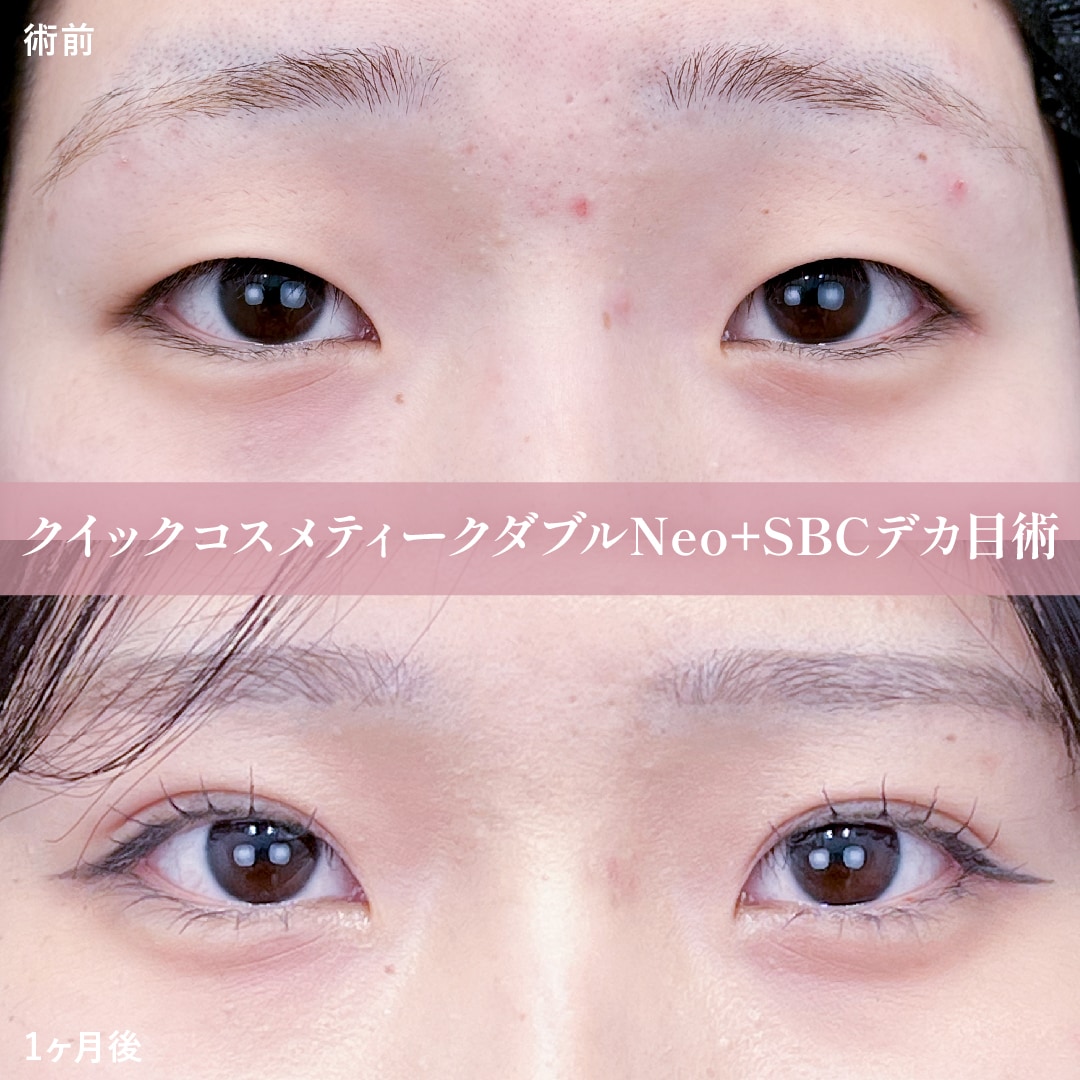 SBCデカ目術
