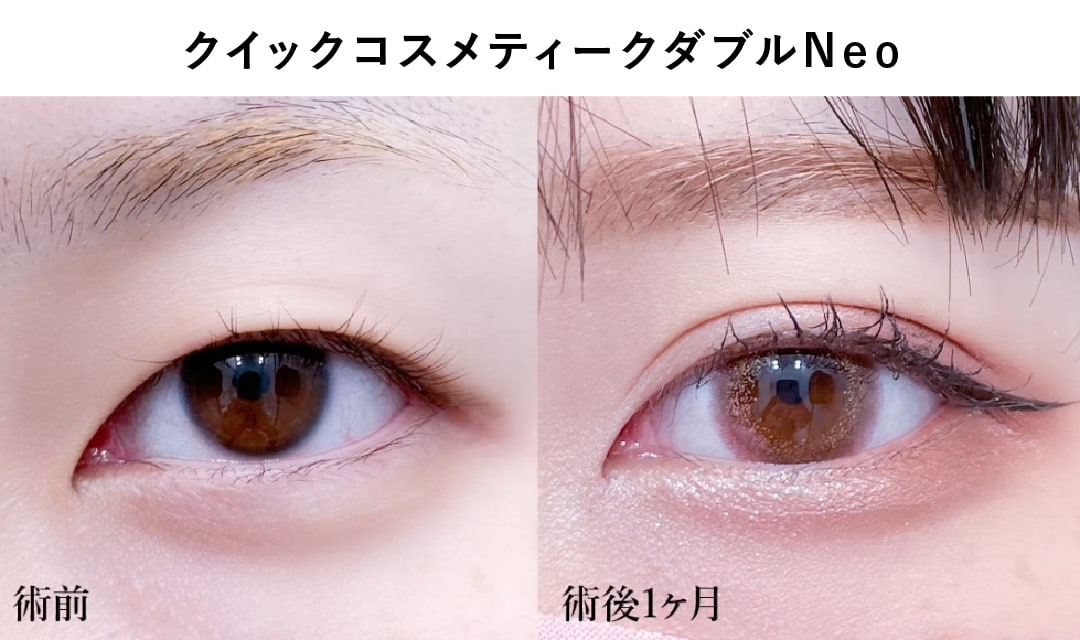 ナチュラルなのに盛れる二重