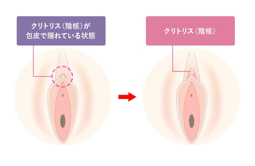 陰核包茎(クリトリス包茎)