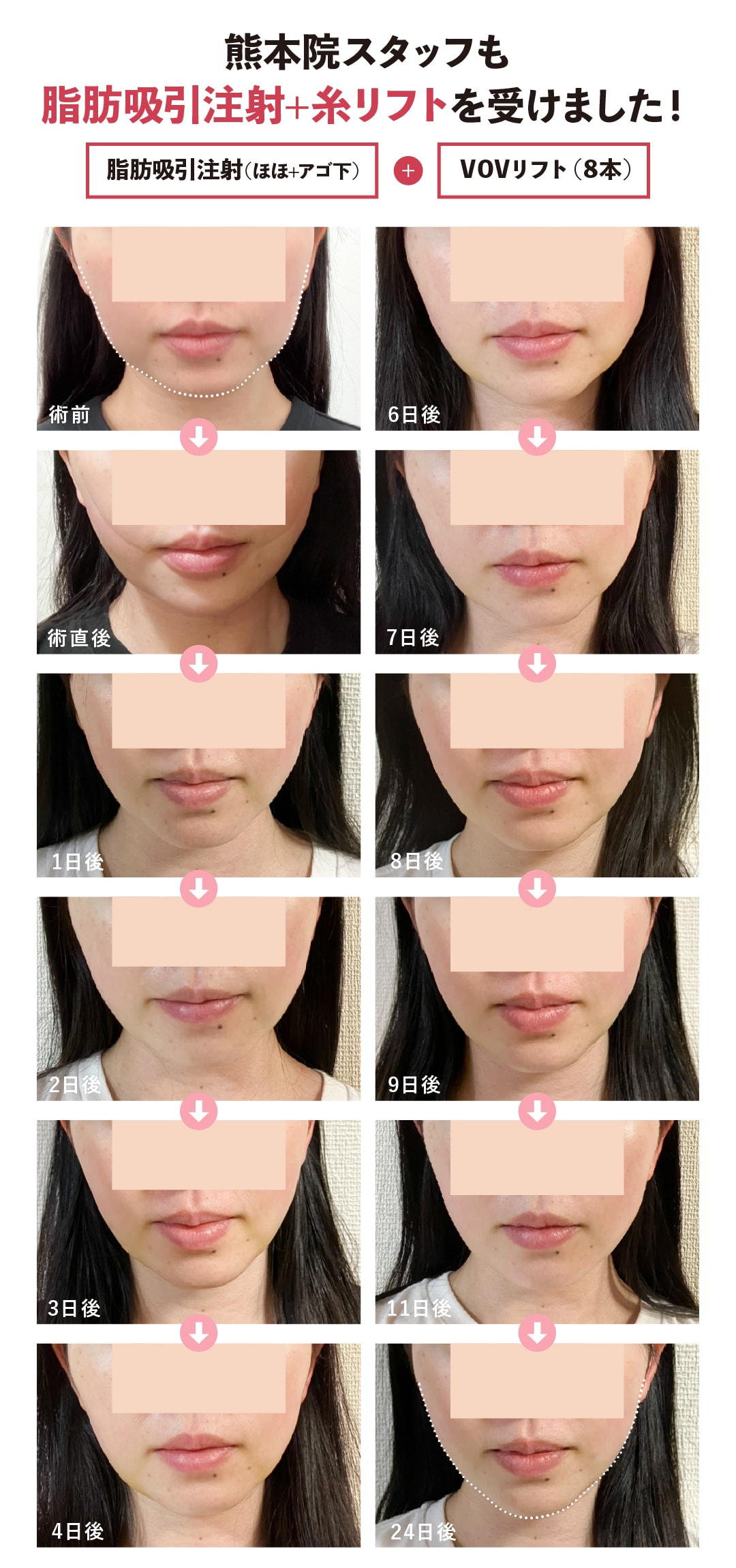 糸 リフト ダウン タイム