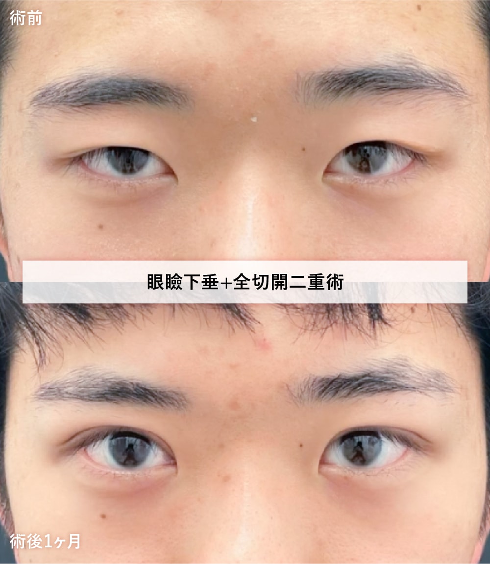 ▲眼瞼下垂+全切開二重術