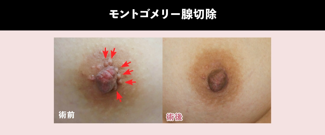 『モントゴメリー腺切除』(乳輪部)<br />
ブツブツを無くして綺麗な乳輪に